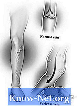 Ce cauzează microvaricele în picioare?