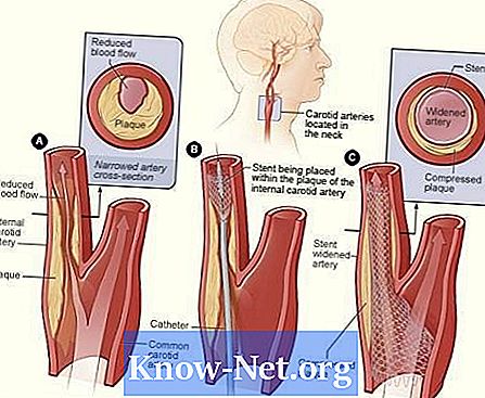 Какви са процедурите за обструкция на каротидните артерии?