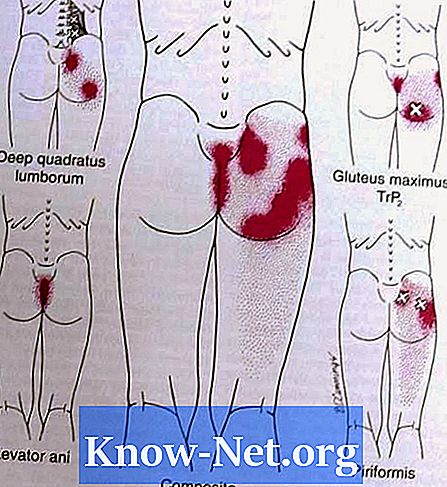 Symptom på sciatic endometrios