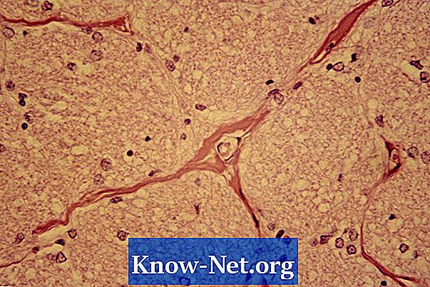 Symtom på kraniell neuropati - Artiklar