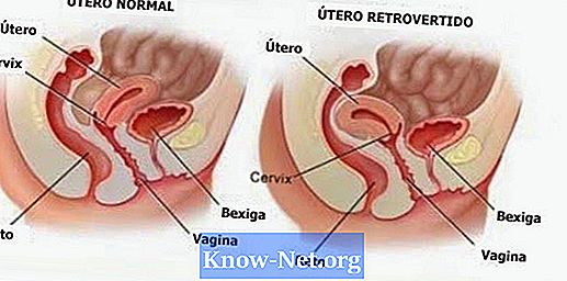 Utérus retroverti et mal de dos