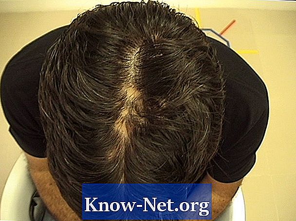 Pengobatan untuk alopecia jaringan parut