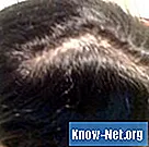 Kaip vartoti beta-sitosterolį kovojant su plaukų slinkimu