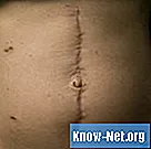 Які методи лікування шрамів після операцій на черевній порожнині?