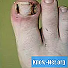 Vilka är behandlingarna för ingrodda tånaglar och naglar?
