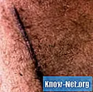 ¿Qué ungüento se debe aplicar a una cicatriz posoperatoria?
