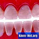 Katere vrste čiščenja lahko opravi zobozdravnik?